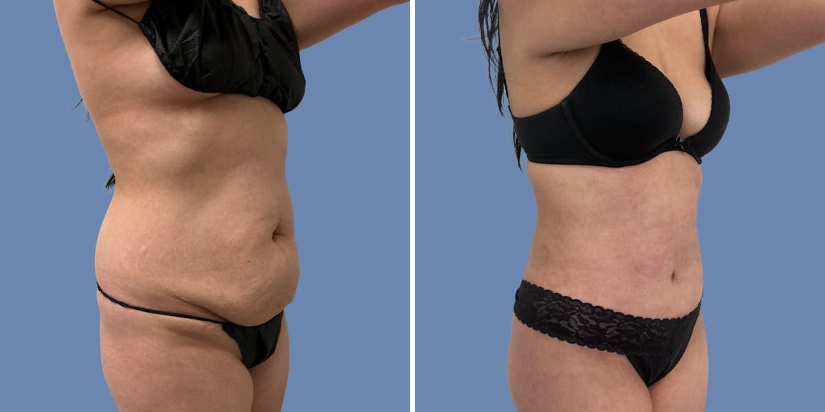 Abdominoplasty Before & After Gallery - Patient 386368 - Image 2