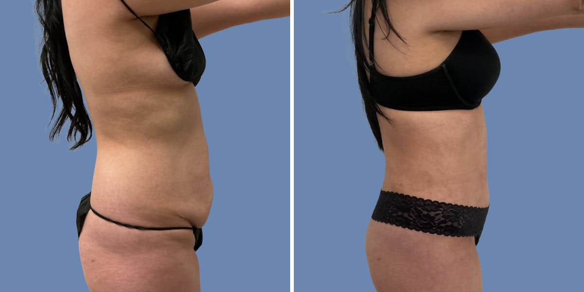 Abdominoplasty Before & After Gallery - Patient 386368 - Image 3