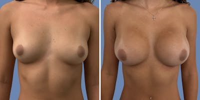 Breast Augmentation Before & After Gallery - Patient 152491 - Image 1