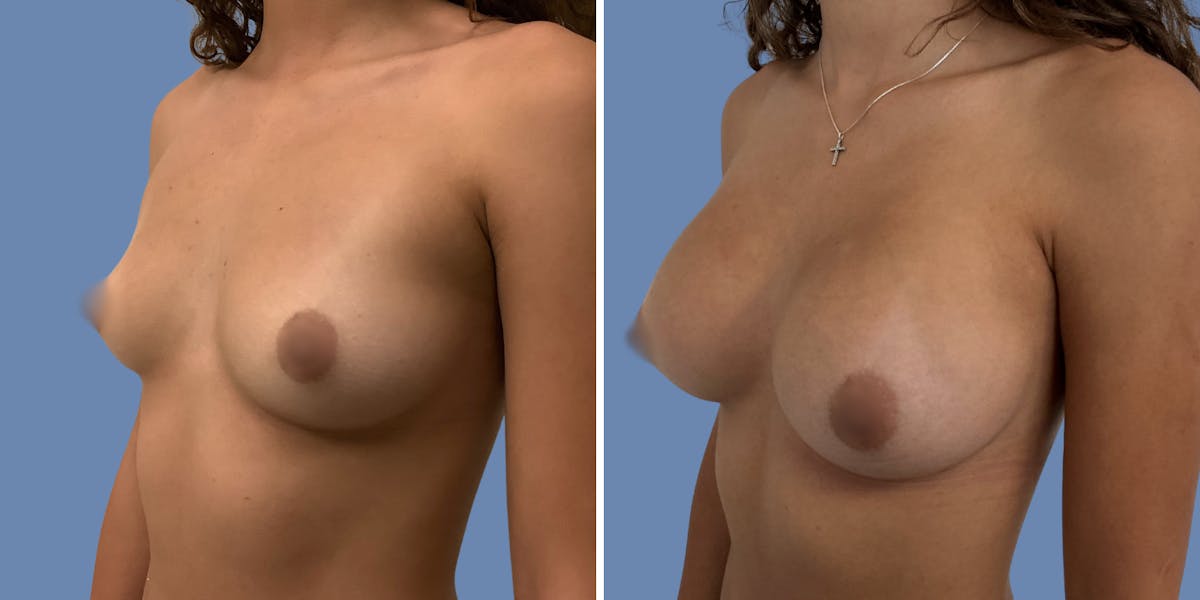 Breast Augmentation Before & After Gallery - Patient 152491 - Image 4