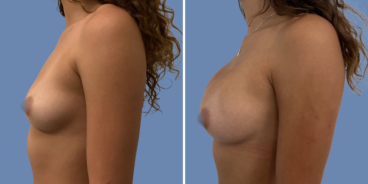 Breast Augmentation Before & After Gallery - Patient 152491 - Image 5
