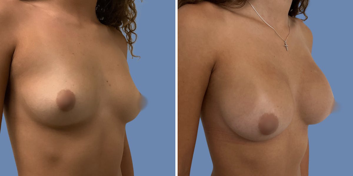 Breast Augmentation Before & After Gallery - Patient 152491 - Image 2