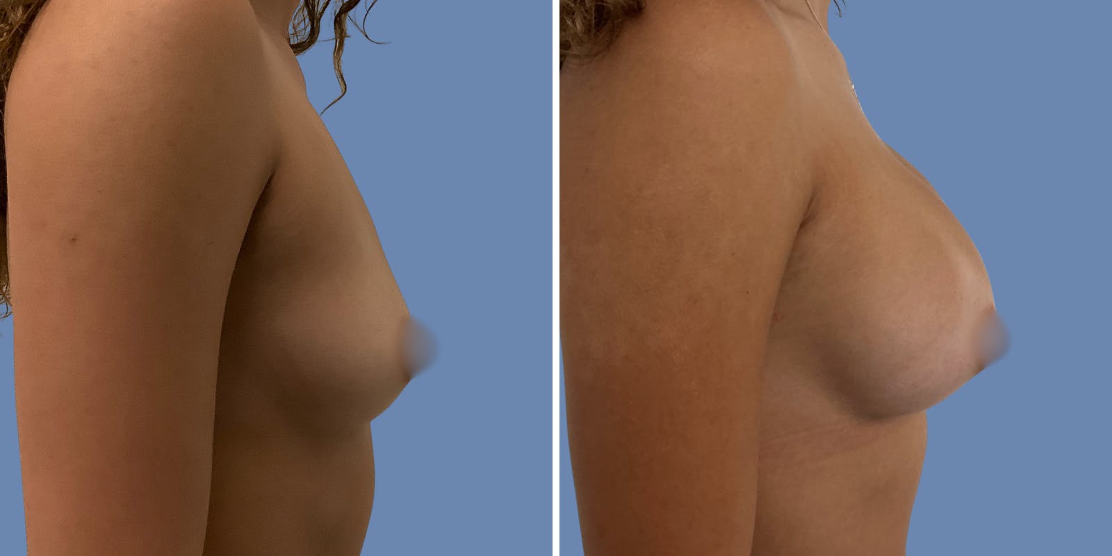Breast Augmentation Before & After Gallery - Patient 152491 - Image 3