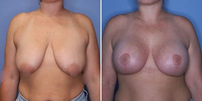 Breast Augmentation Before & After Gallery - Patient 177432 - Image 1