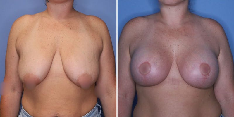 Patient OtPRhh8YSSSQQQTJJ9zgMQ - Breast Augmentation Before & After Photos