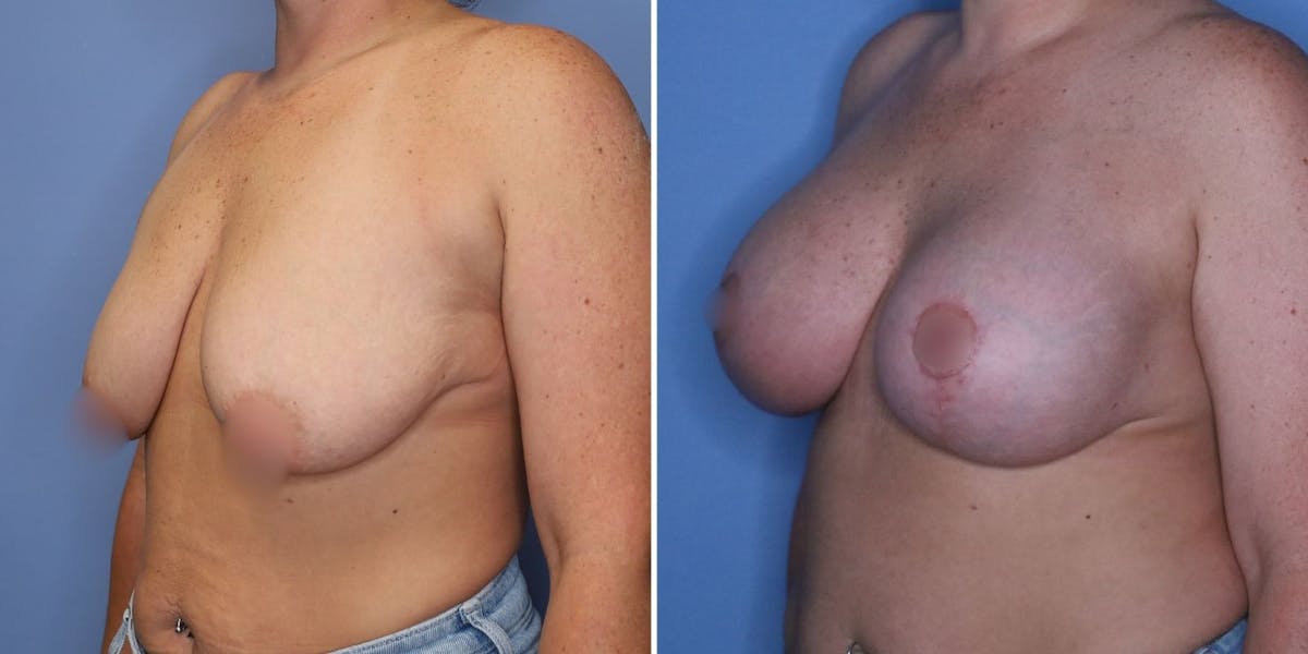 Breast Augmentation Before & After Gallery - Patient 177432 - Image 5