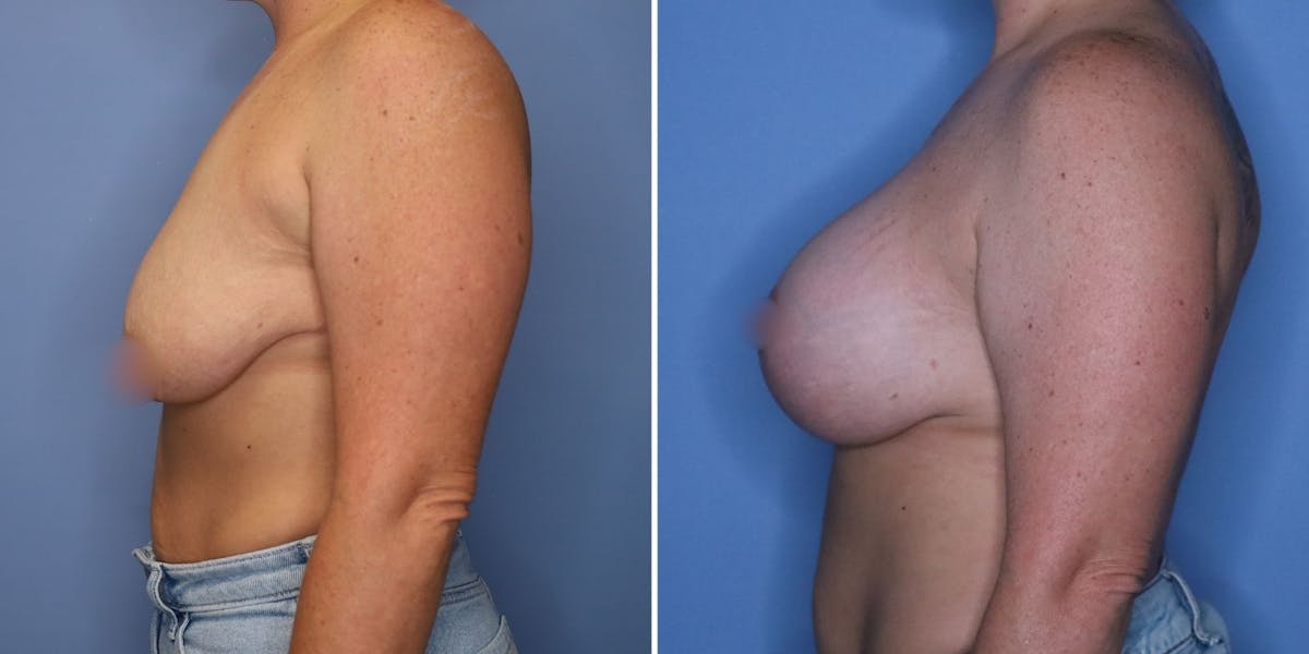Breast Augmentation Before & After Gallery - Patient 177432 - Image 4