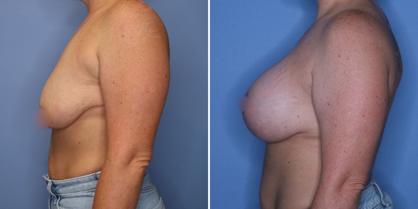 Breast Augmentation Before & After Gallery - Patient 177432 - Image 4