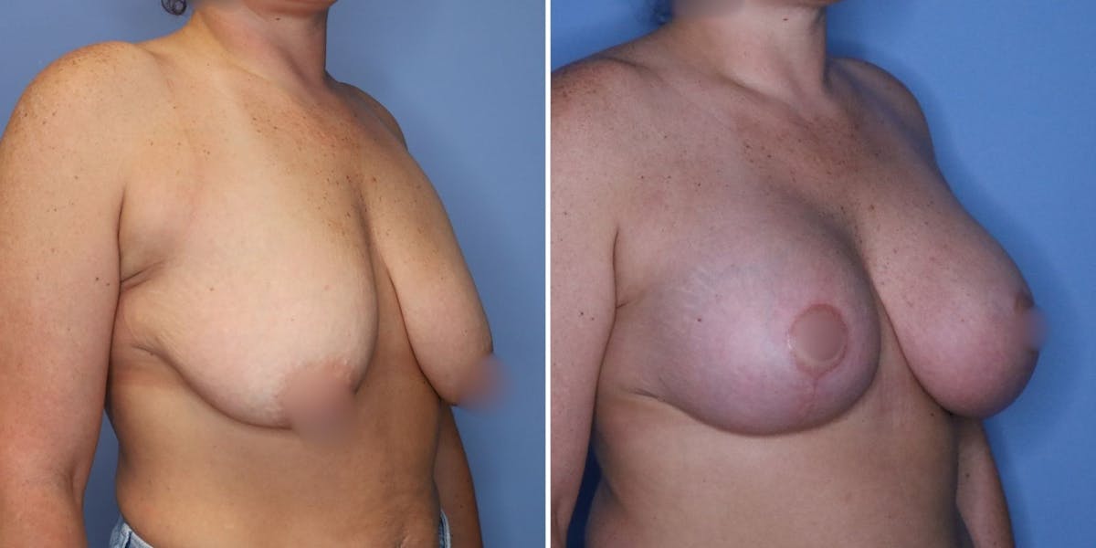 Breast Augmentation Before & After Gallery - Patient 177432 - Image 2