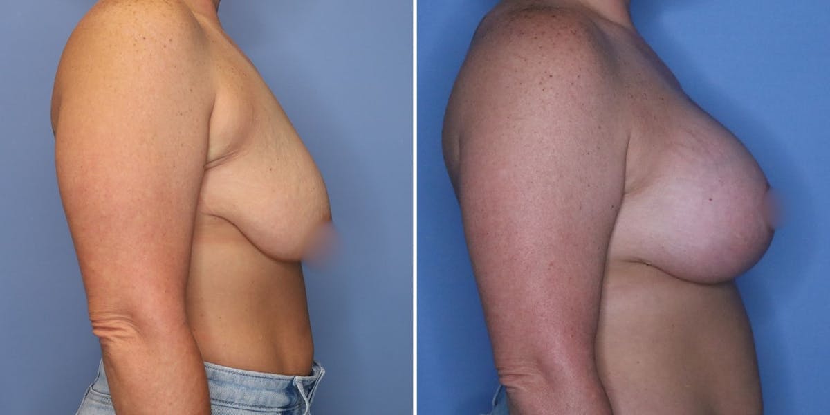 Breast Augmentation Before & After Gallery - Patient 177432 - Image 3
