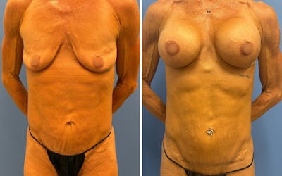 Abdominoplasty Before & After Gallery - Patient 265989 - Image 1