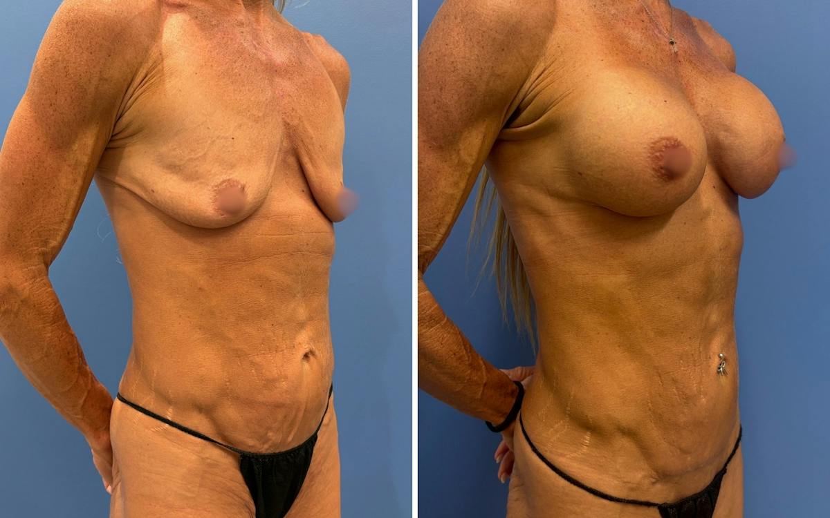 Abdominoplasty Before & After Gallery - Patient 265989 - Image 2