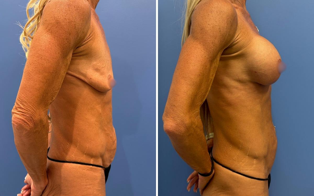 Abdominoplasty Before & After Gallery - Patient 265989 - Image 3
