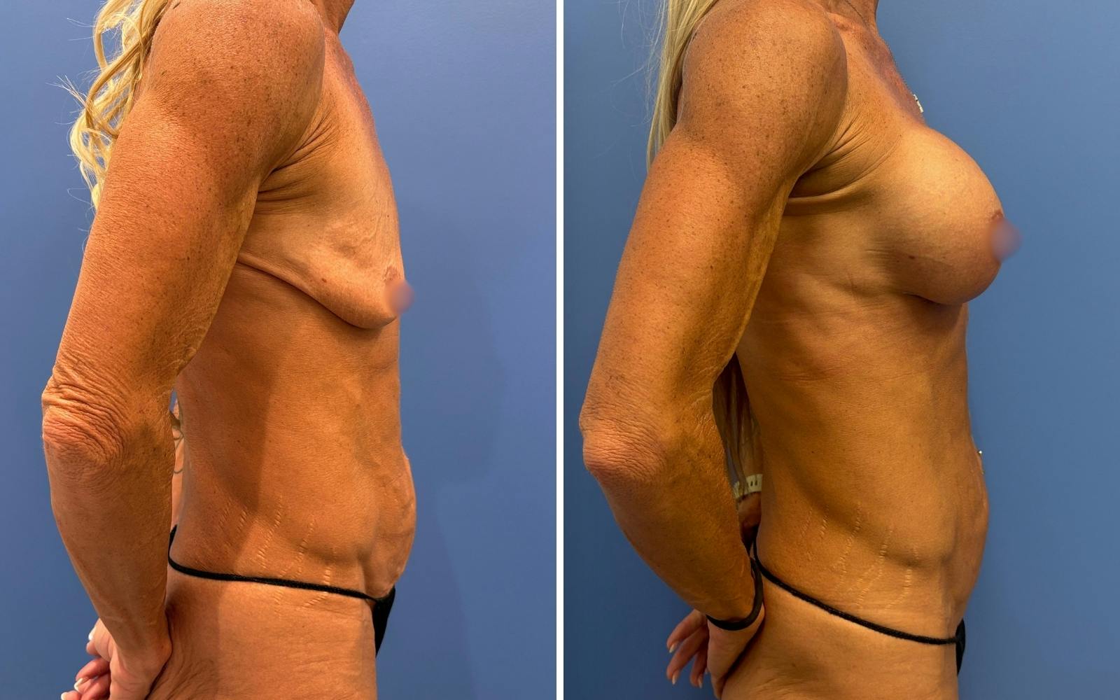 Abdominoplasty Before & After Gallery - Patient 265989 - Image 3