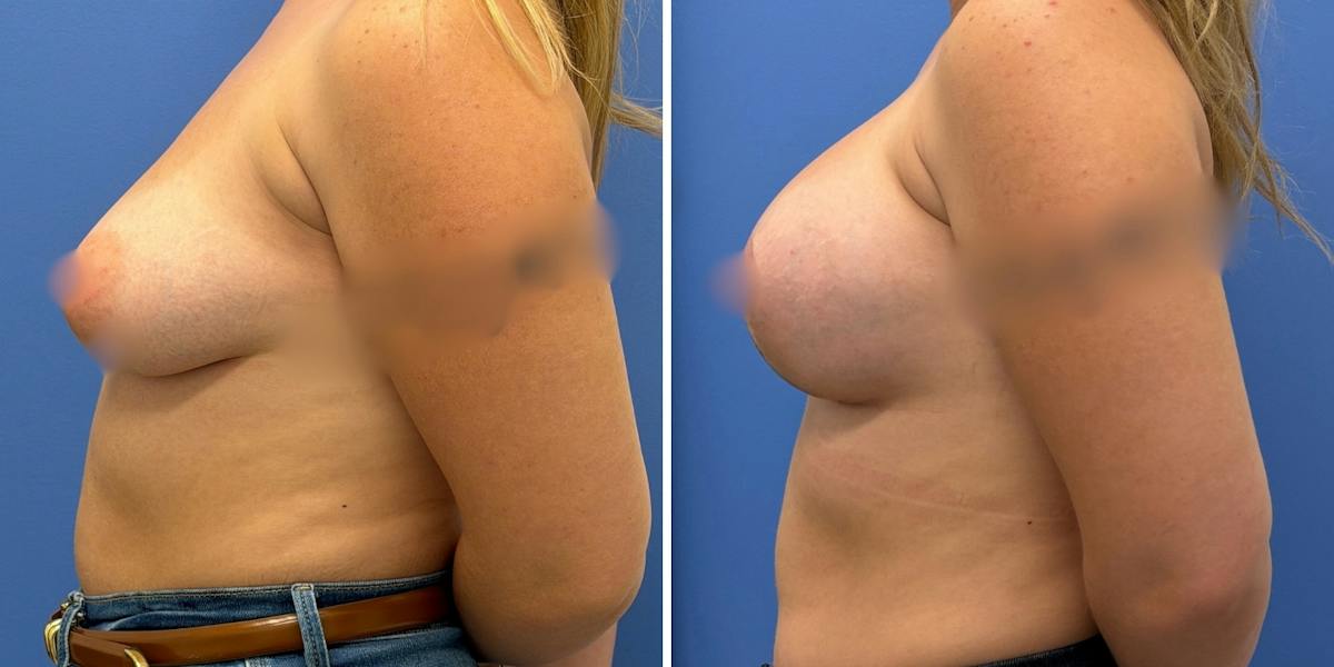 Breast Augmentation & Lift Before & After Gallery - Patient 226610 - Image 3
