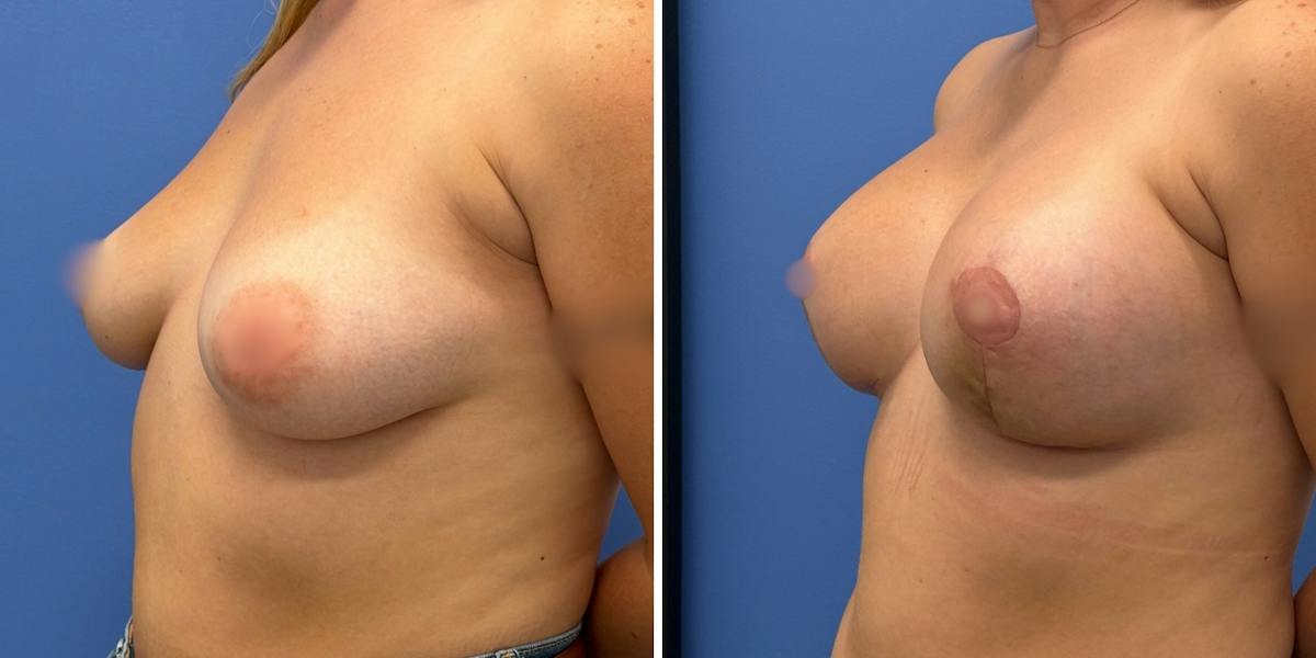 Breast Augmentation & Lift Before & After Gallery - Patient 226610 - Image 2