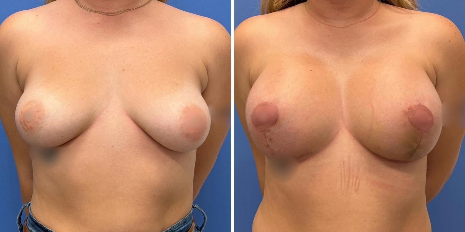 Breast Augmentation & Lift Before & After Gallery - Patient 226610 - Image 1