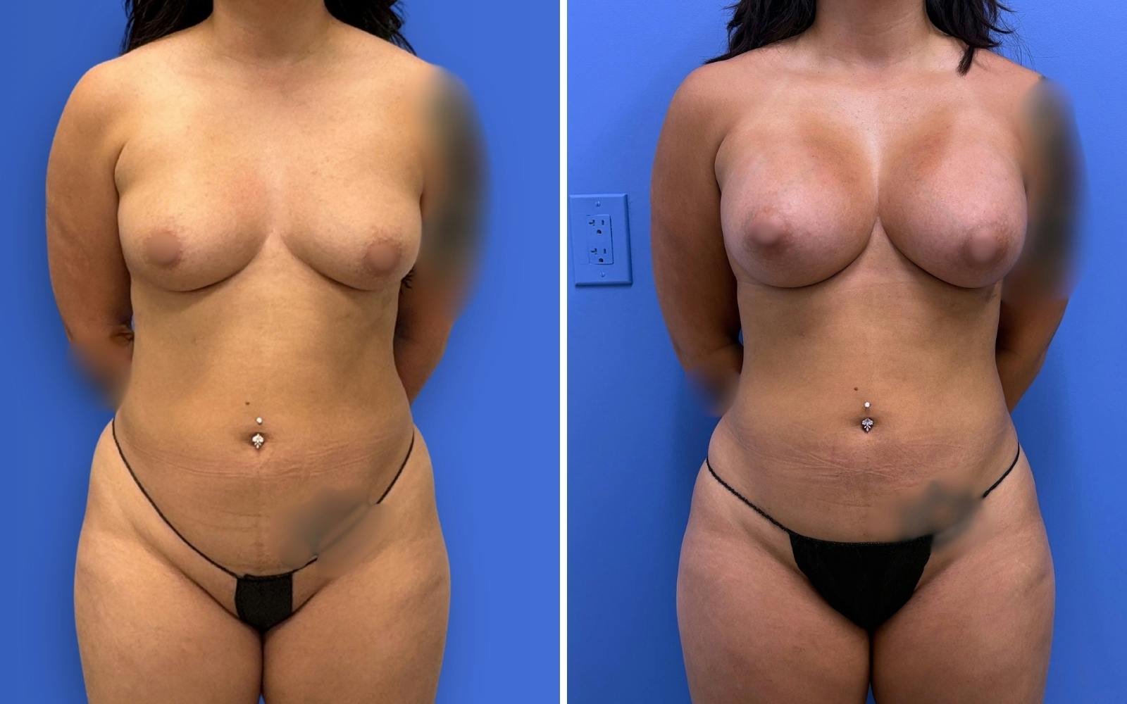 Liposuction Before & After Gallery - Patient 224294 - Image 1
