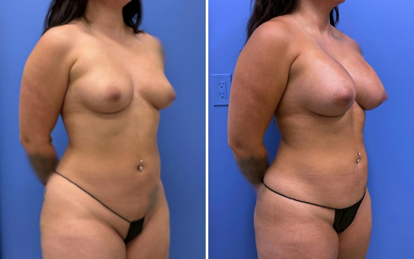 Liposuction Before & After Gallery - Patient 224294 - Image 2