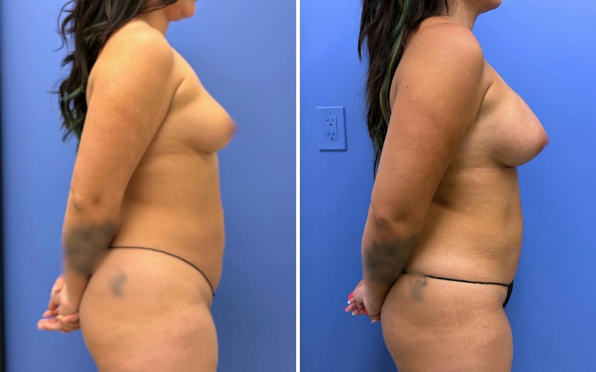 Liposuction Before & After Gallery - Patient 224294 - Image 3