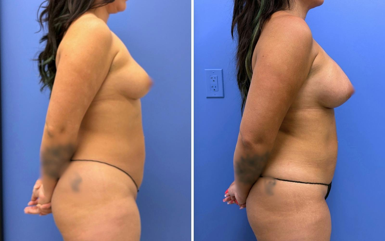 Liposuction Before & After Gallery - Patient 224294 - Image 3