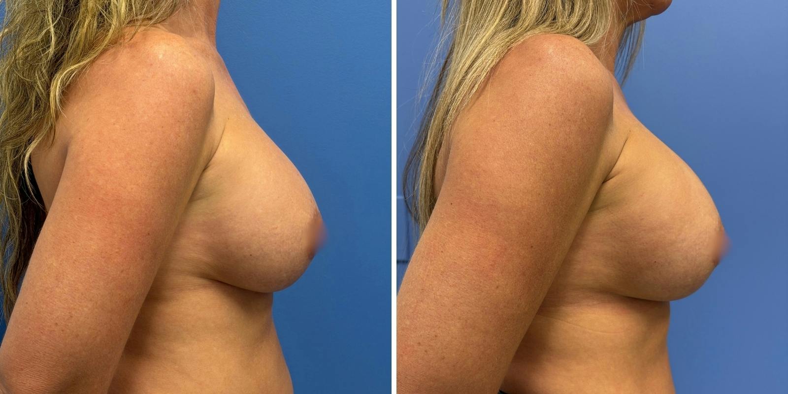 Explant Before & After Gallery - Patient 359064 - Image 3