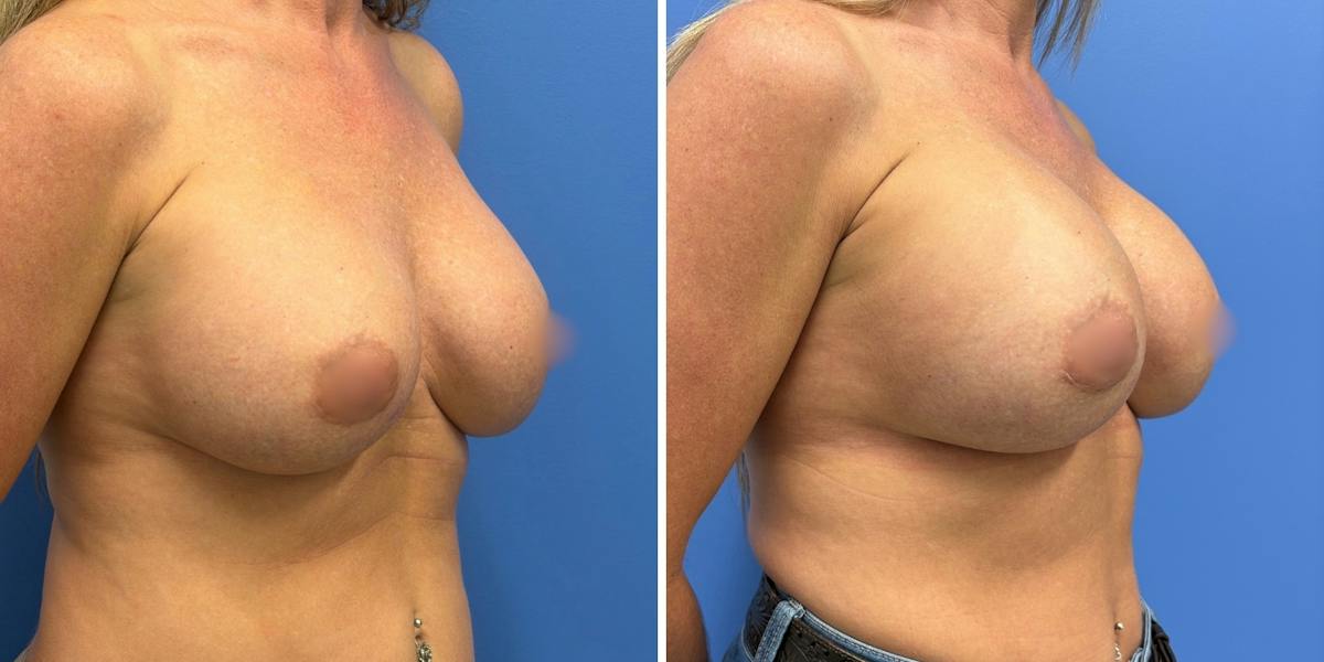 Explant Before & After Gallery - Patient 359064 - Image 2