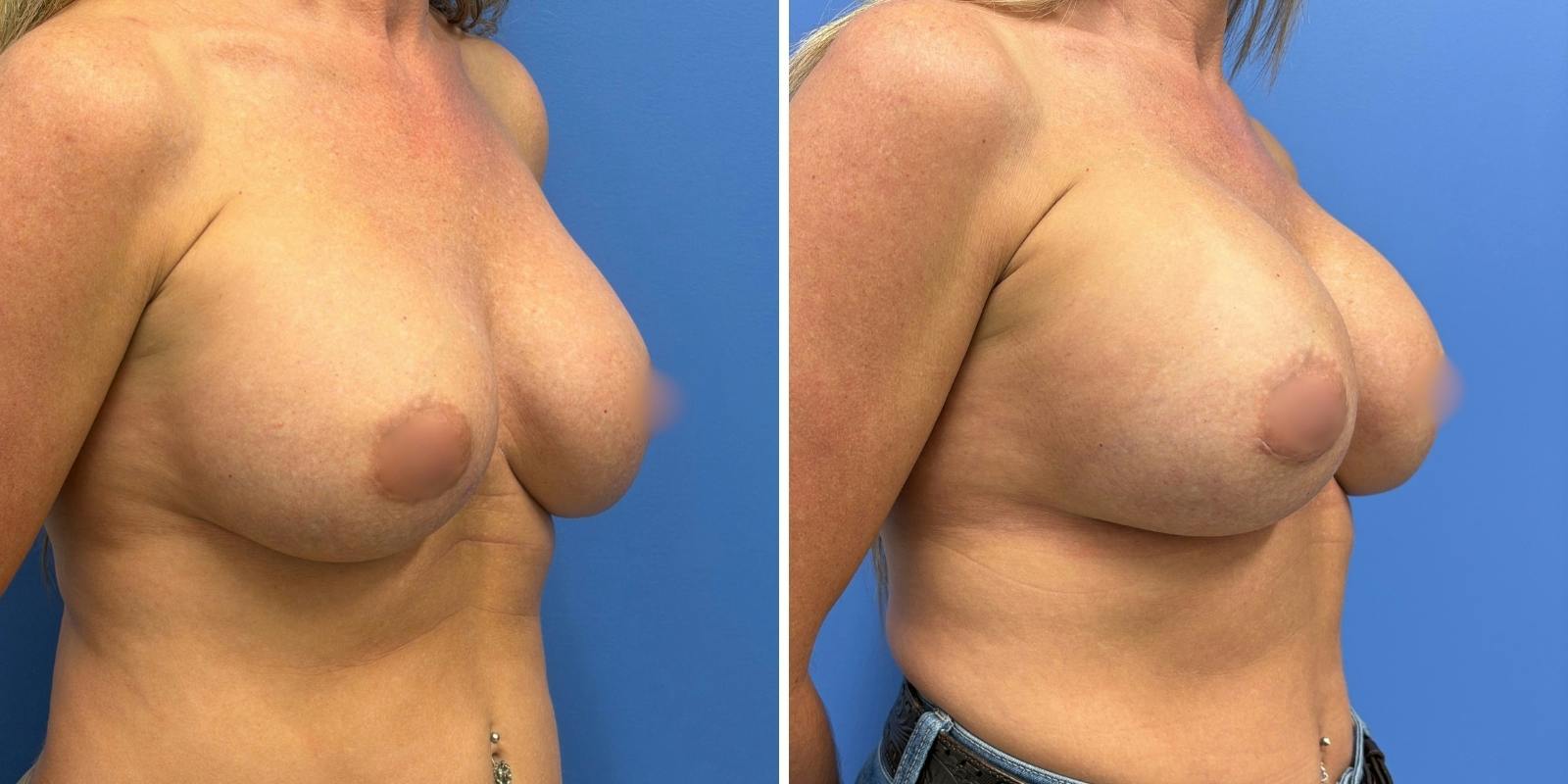Explant Before & After Gallery - Patient 359064 - Image 2