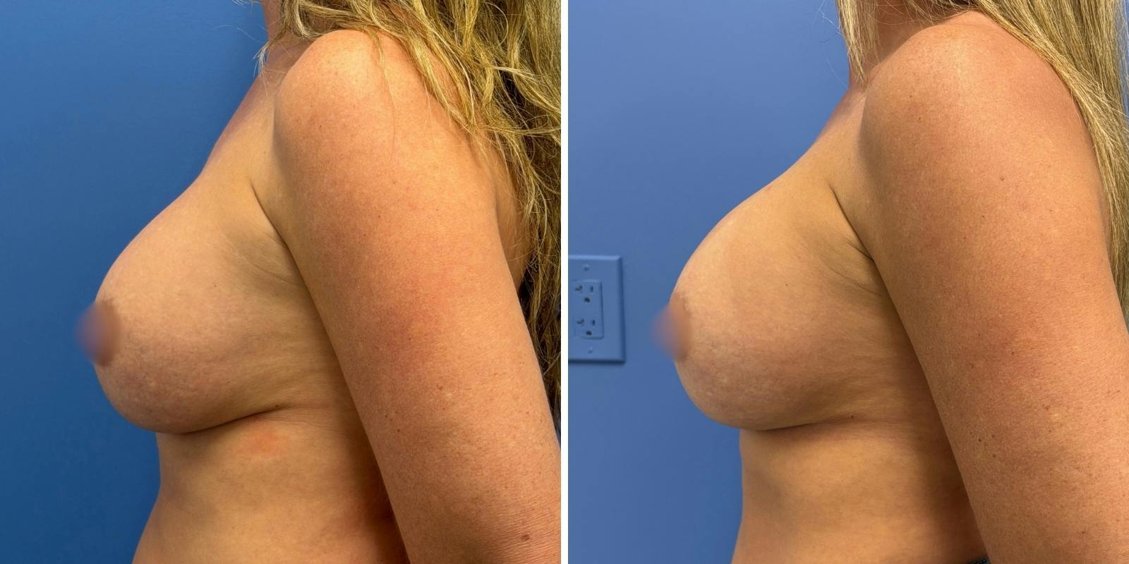 Explant Before & After Gallery - Patient 359064 - Image 5