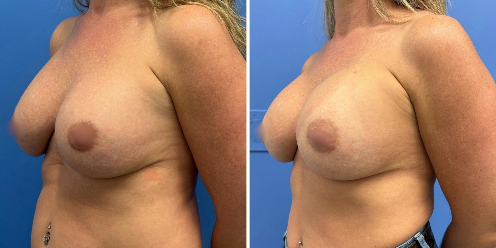 Explant Before & After Gallery - Patient 359064 - Image 4