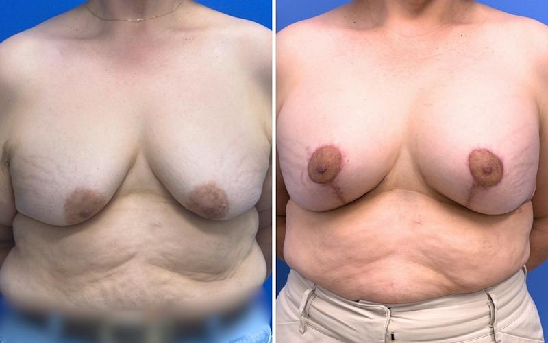 Patient bkYvIZRkTF2QPoWG_2RZhQ - Breast Augmentation & Lift Before & After Photos