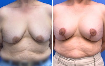 Breast Augmentation & Lift Before & After Gallery - Patient 115741 - Image 1