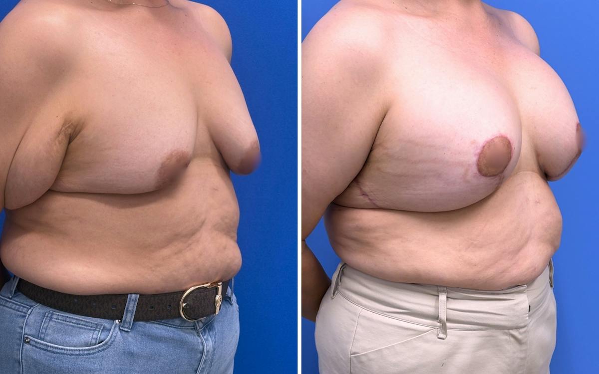Breast Augmentation & Lift Before & After Gallery - Patient 115741 - Image 2