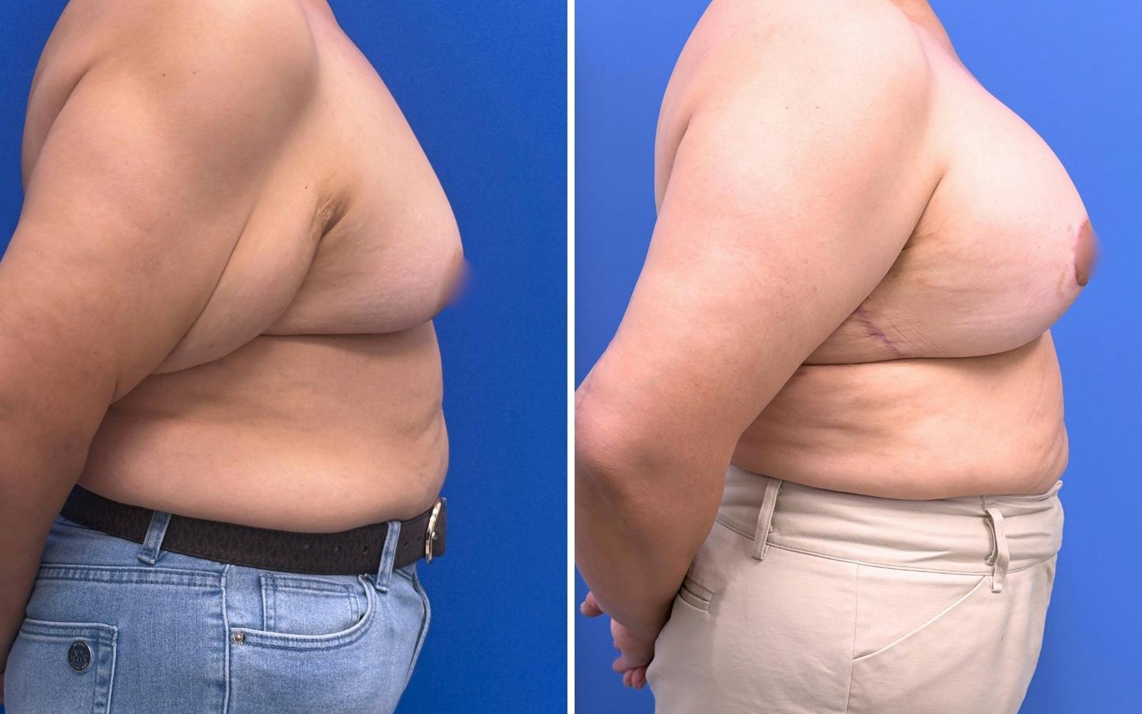 Breast Augmentation & Lift Before & After Gallery - Patient 115741 - Image 3