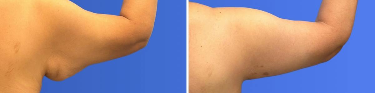 Breast Augmentation & Lift Before & After Gallery - Patient 115741 - Image 5