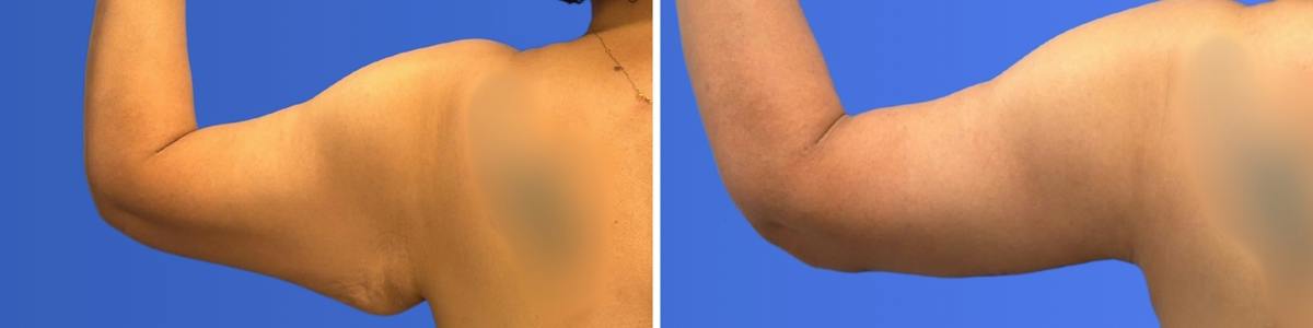 Breast Augmentation & Lift Before & After Gallery - Patient 115741 - Image 6