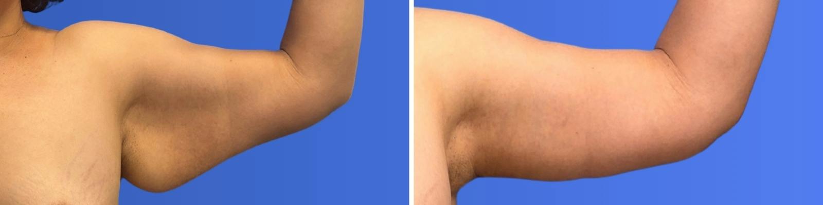Breast Augmentation & Lift Before & After Gallery - Patient 115741 - Image 7