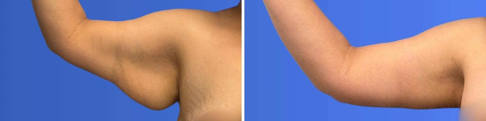 Breast Augmentation & Lift Before & After Gallery - Patient 115741 - Image 4
