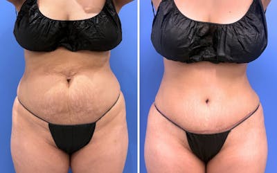 Abdominoplasty Before & After Gallery - Patient 249187 - Image 1