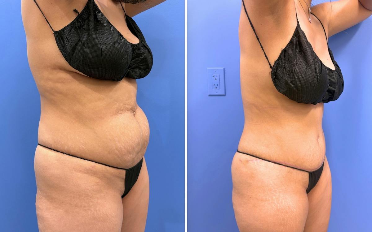 Abdominoplasty Before & After Gallery - Patient 249187 - Image 2