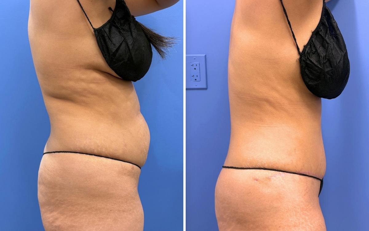 Abdominoplasty Before & After Gallery - Patient 249187 - Image 3