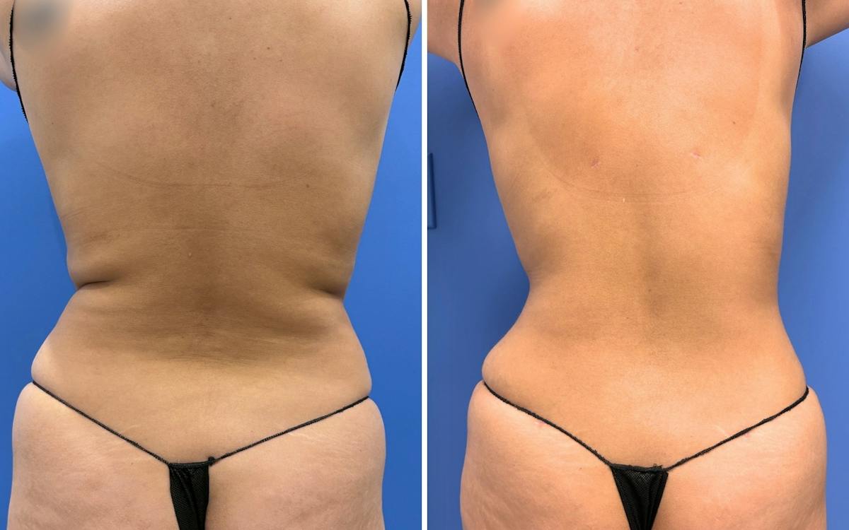 Abdominoplasty Before & After Gallery - Patient 249187 - Image 4