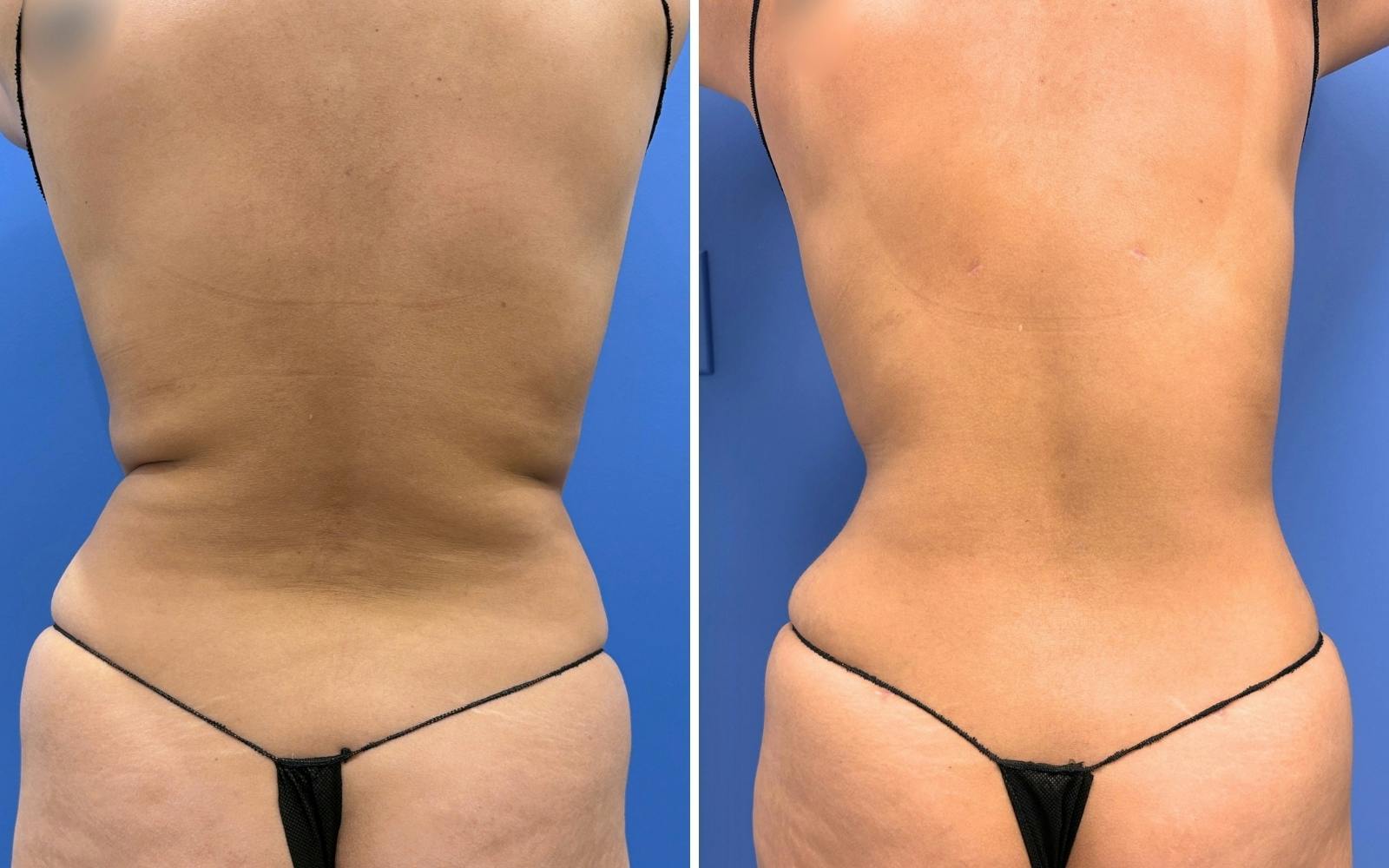 Abdominoplasty Before & After Gallery - Patient 249187 - Image 4