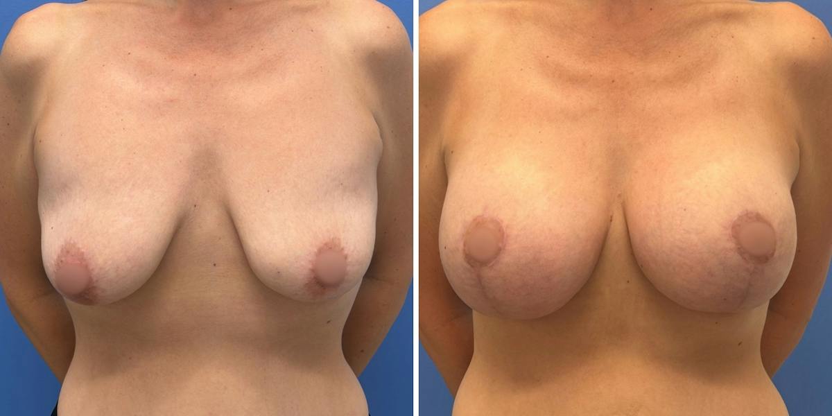 Breast Augmentation & Lift Before & After Gallery - Patient 340685 - Image 1