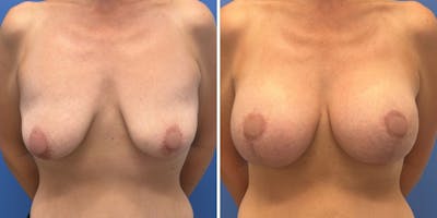 Breast Augmentation & Lift Before & After Gallery - Patient 340685 - Image 1