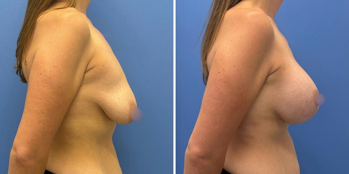 Breast Augmentation & Lift Before & After Gallery - Patient 340685 - Image 3