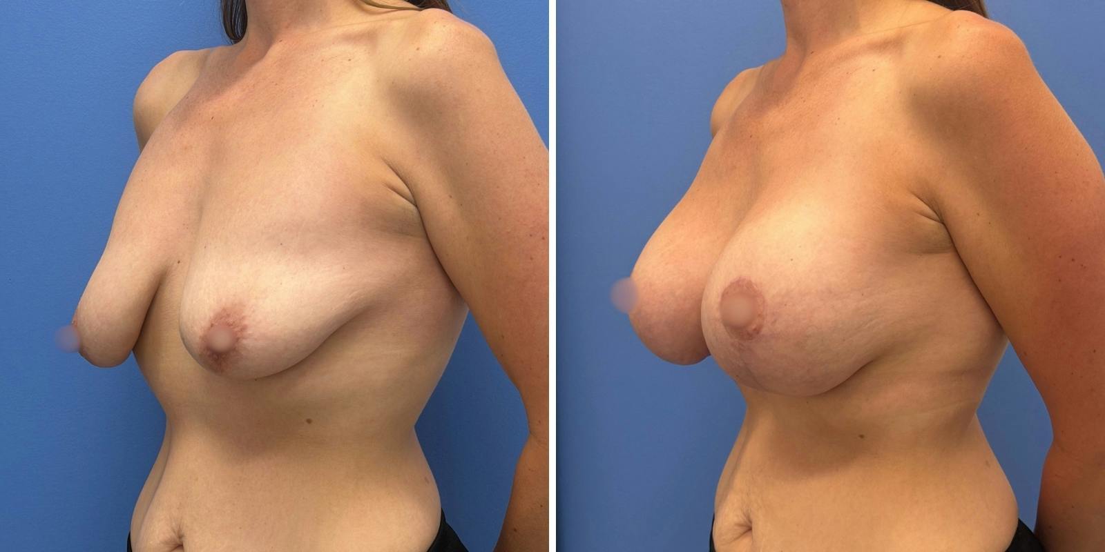Breast Augmentation & Lift Before & After Gallery - Patient 340685 - Image 4