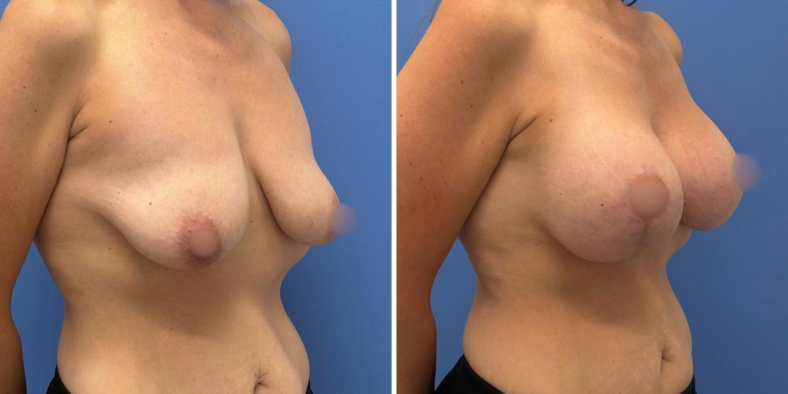 Breast Augmentation & Lift Before & After Gallery - Patient 340685 - Image 2