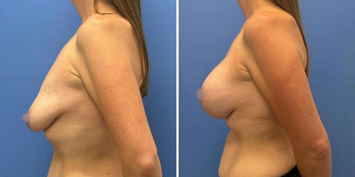 Breast Augmentation & Lift Before & After Gallery - Patient 340685 - Image 5
