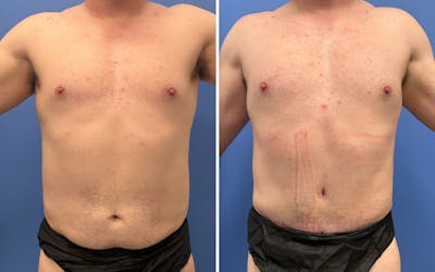 Abdominoplasty Before & After Gallery - Patient 159783 - Image 1